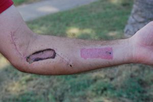 Gila Monster Bite